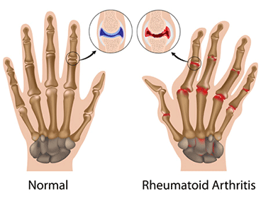 Rheumatoid Arthritis Ayurveda
