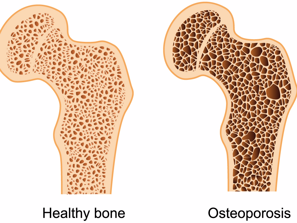 Treating Osteoporosis the natural way 