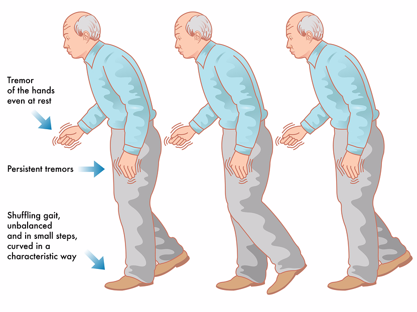 Tackling Parkinson’s with Ayurveda