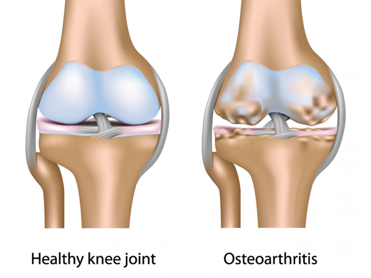 Ayurveda for Osteoarthritis 