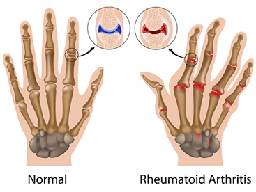 Rheumatoid Arthritis and Ayurveda