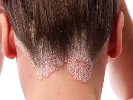 Psoriasis Cure In Ayurveda |